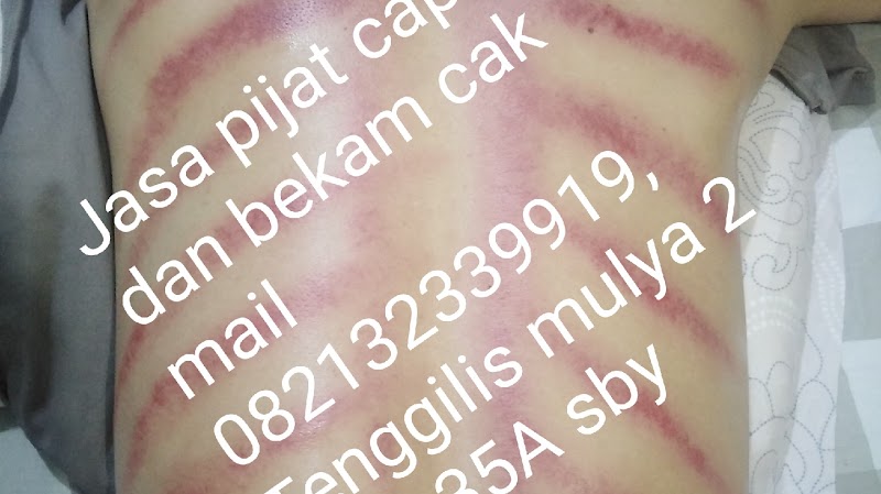 Pijat capek, relaksasi, kebugaran, keluhan, krek/kretek , bekam. Area surabaya, sidoarjo bekam cak mail di Wonocolo